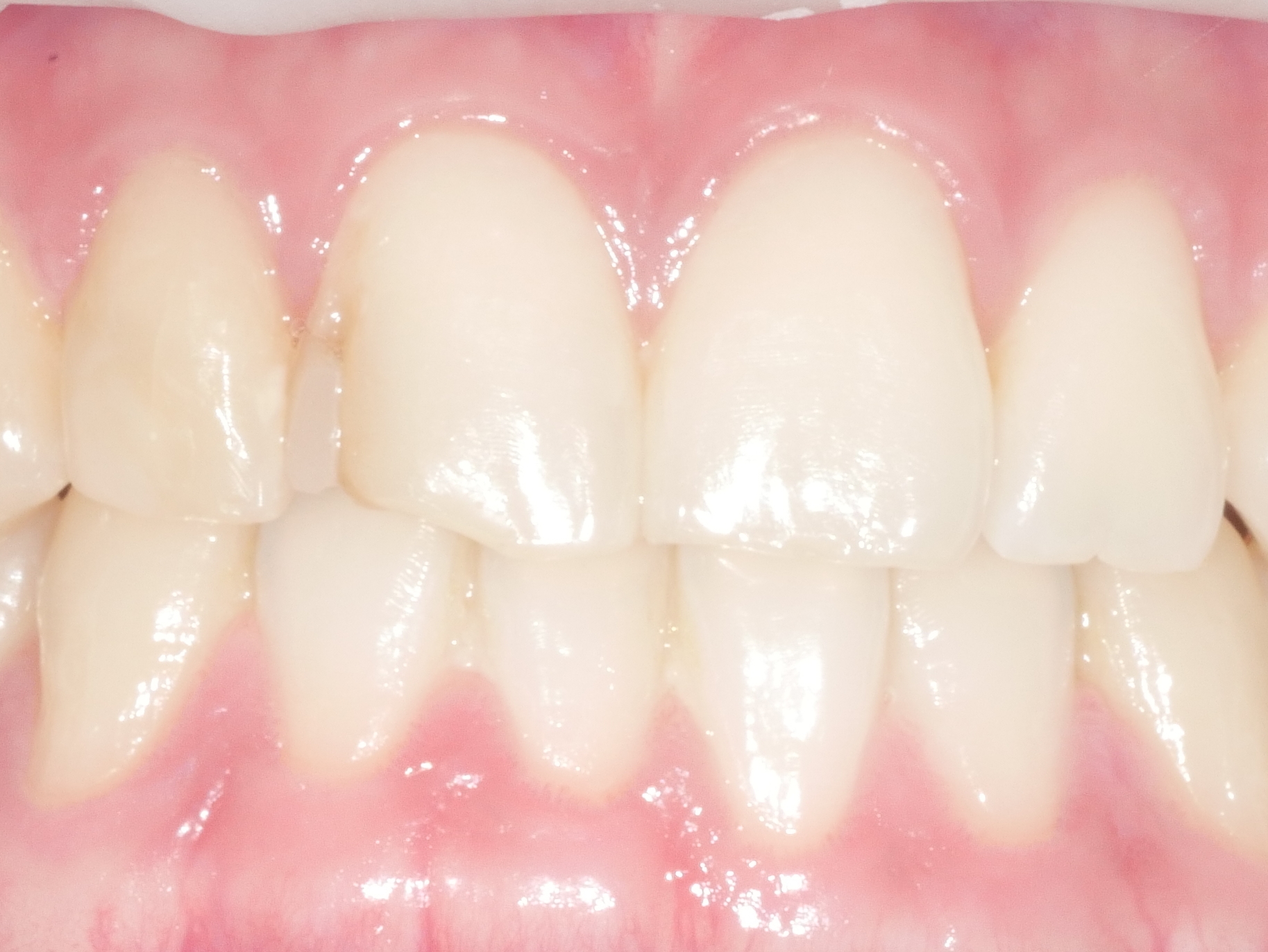 앞니 충치 레진치료