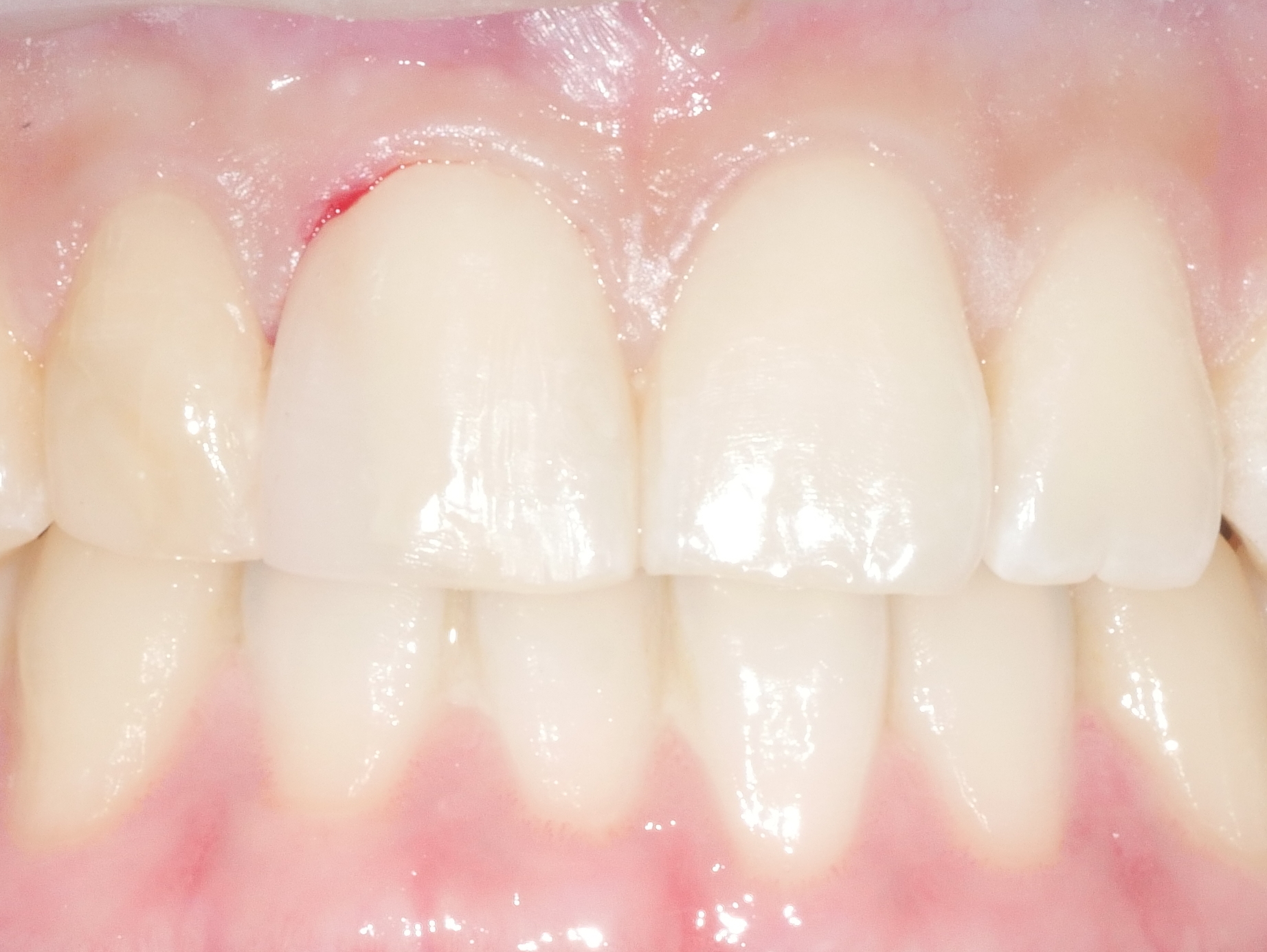 앞니 충치 레진치료