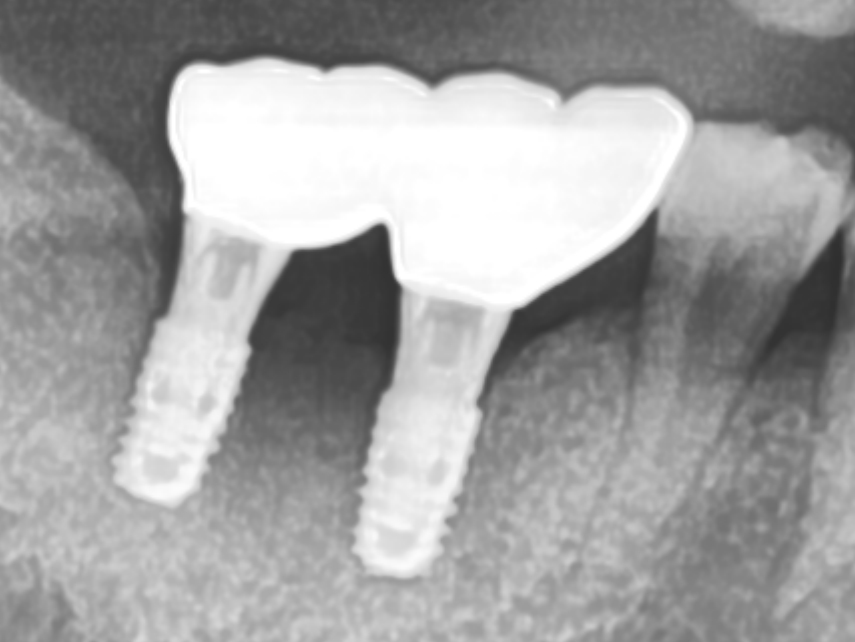 임플란트 재치료