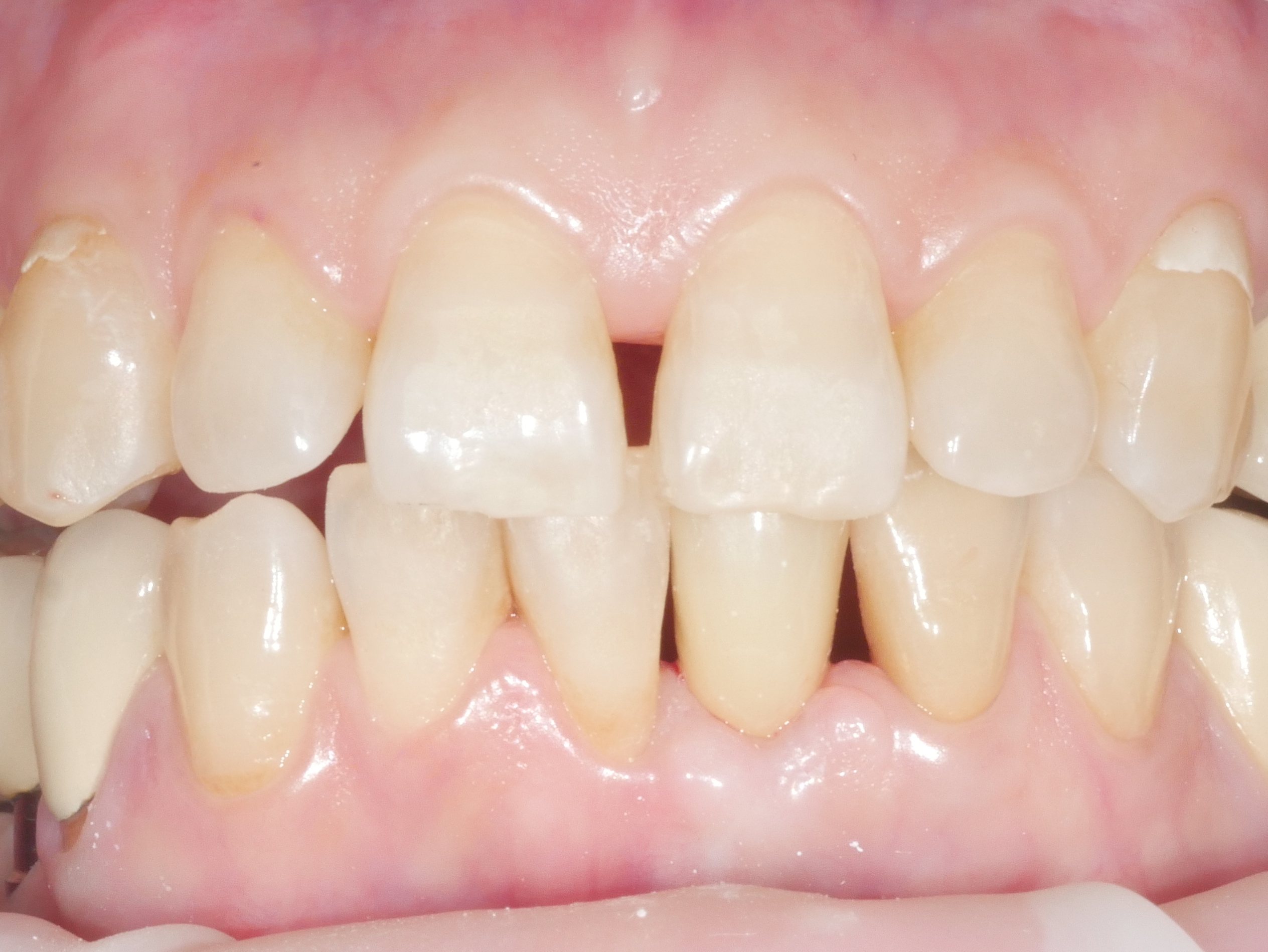 아래 앞니 임플란트